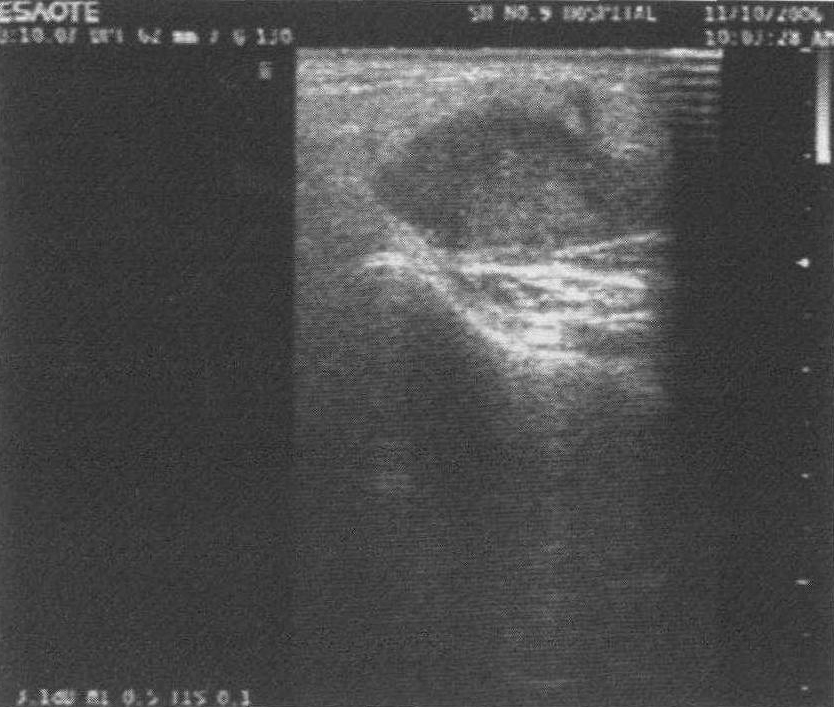 其他惡性腫瘤